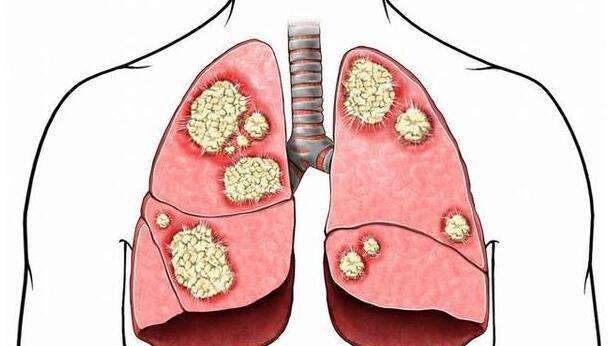 肺癌早期有三大症状，或常被当成普通病症，请你多加注意