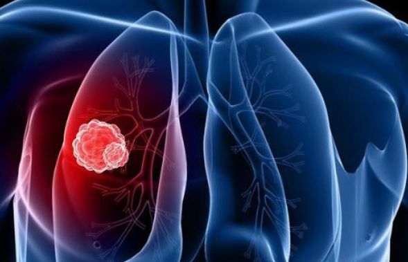 肺癌初期身体会出现什么状况