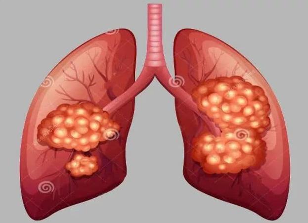 肺癌早期能活多久一般？肺癌的早期症状是什么