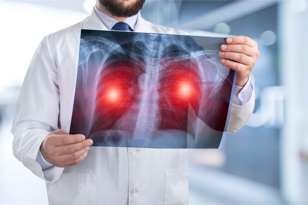肺癌初期怎么治疗好 肺癌早期这个方法安全有效