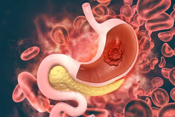 胃癌早期能活多久一般 胃癌早期能治好吗能活多久？