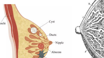 乳腺癌的早期症状和前兆 胸部会出现4个异常症状