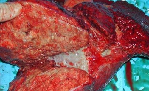 肝癌中期图片图片